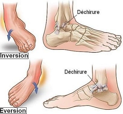 Ankle sprain in football